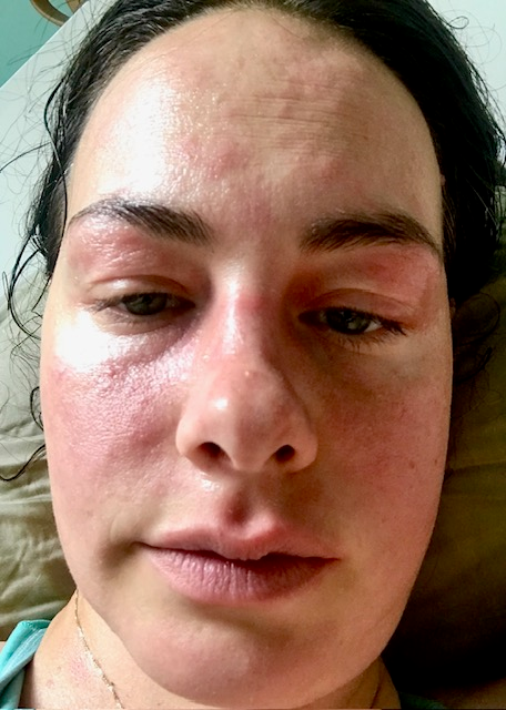 a woman's face covered in painful eczema